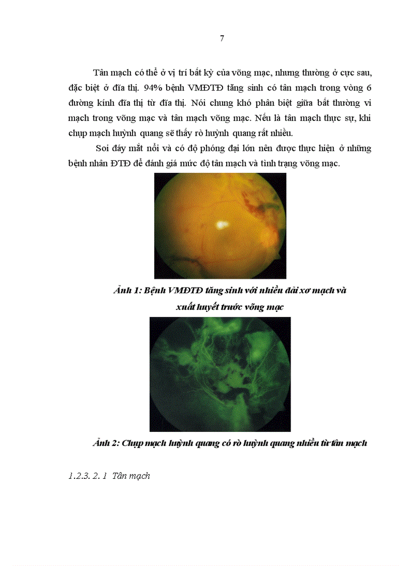 image for page Đánh giá hiệu quả sử dụng thuốc Avastin trong điều trị tân mạch võng mạc do đái tháo đường