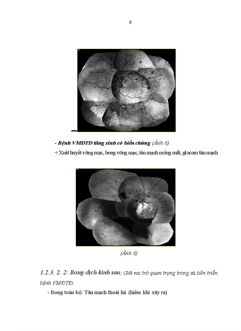 image for page Đánh giá hiệu quả sử dụng thuốc Avastin trong điều trị tân mạch võng mạc do đái tháo đường