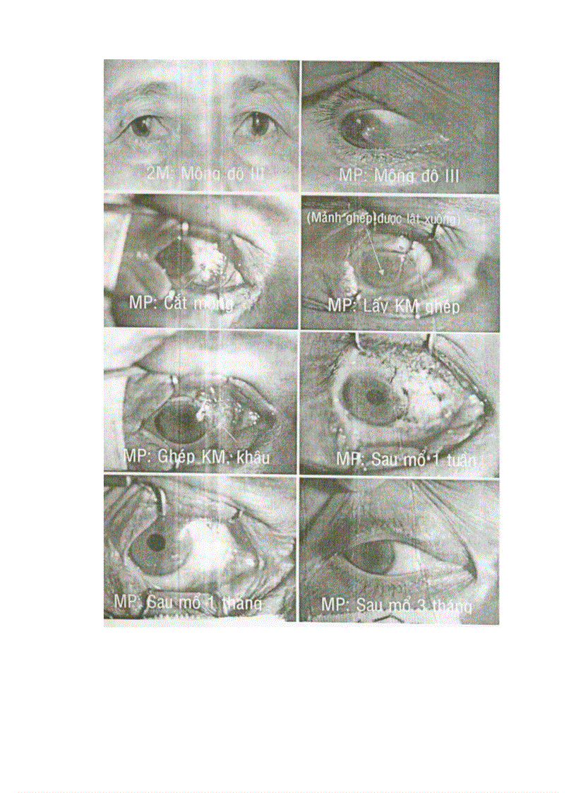 image for page Kỹ thuật cắt mộng thịt nguyên phát ghép kết mạc tự thân mảnh rộng