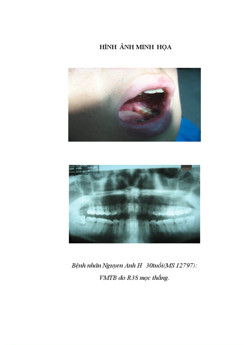 image for page Nhận xét tình trạng mọc răng và kết quả xử trí các tai biến ở bệnh nhân răng khôn hàm dưới tại Bệnh viện răng hàm mặt trung ương Hà nội
