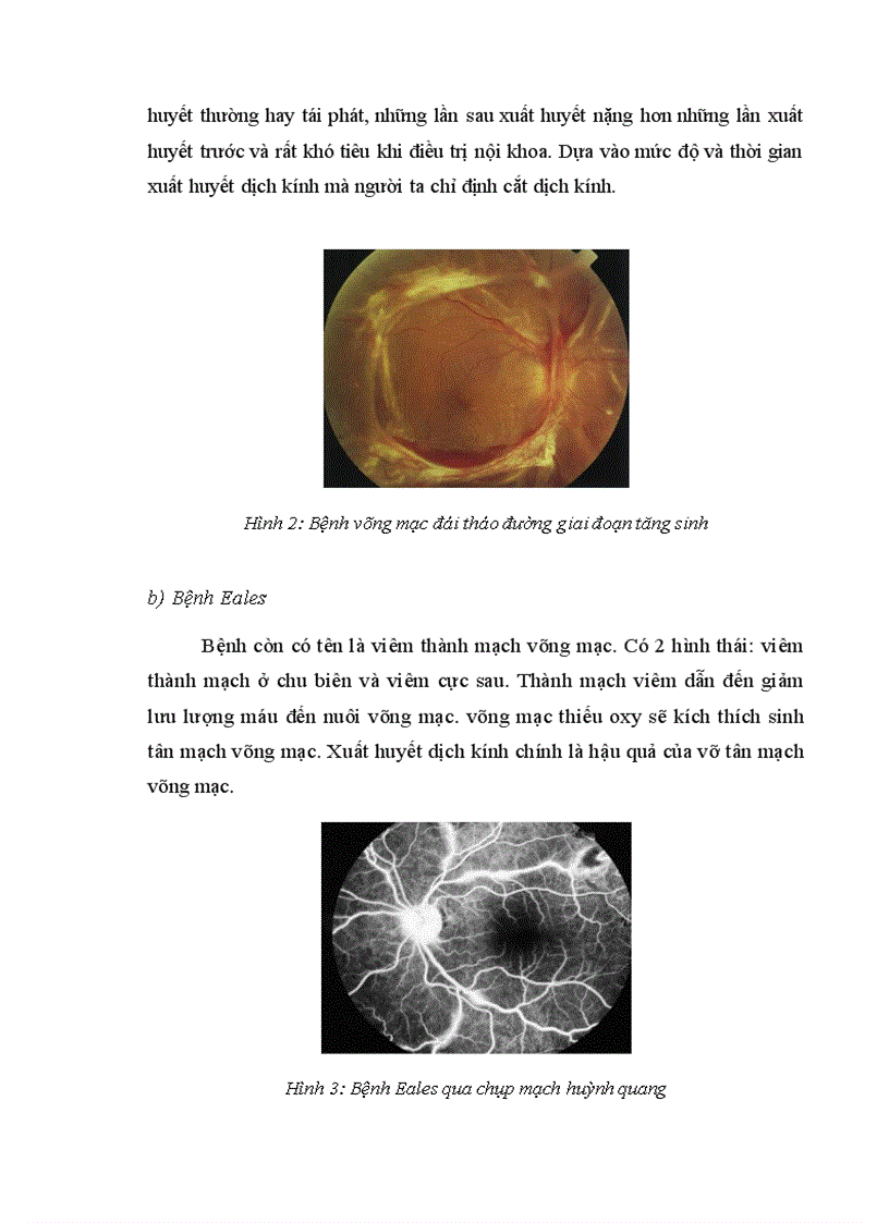 image for page Đánh giá kết quả phẫu thuật cắt dịch kính điều trị một số hình thái xuất huyết dịch kính nội sinh
