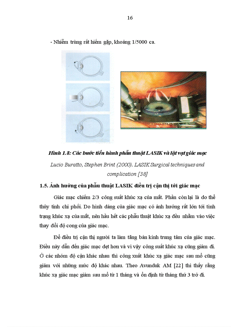 image for page Nghiên cứu sự thay đổi thị lực và khúc xạ sau phẫu thuật Lasik và một số yếu tố liên quan
