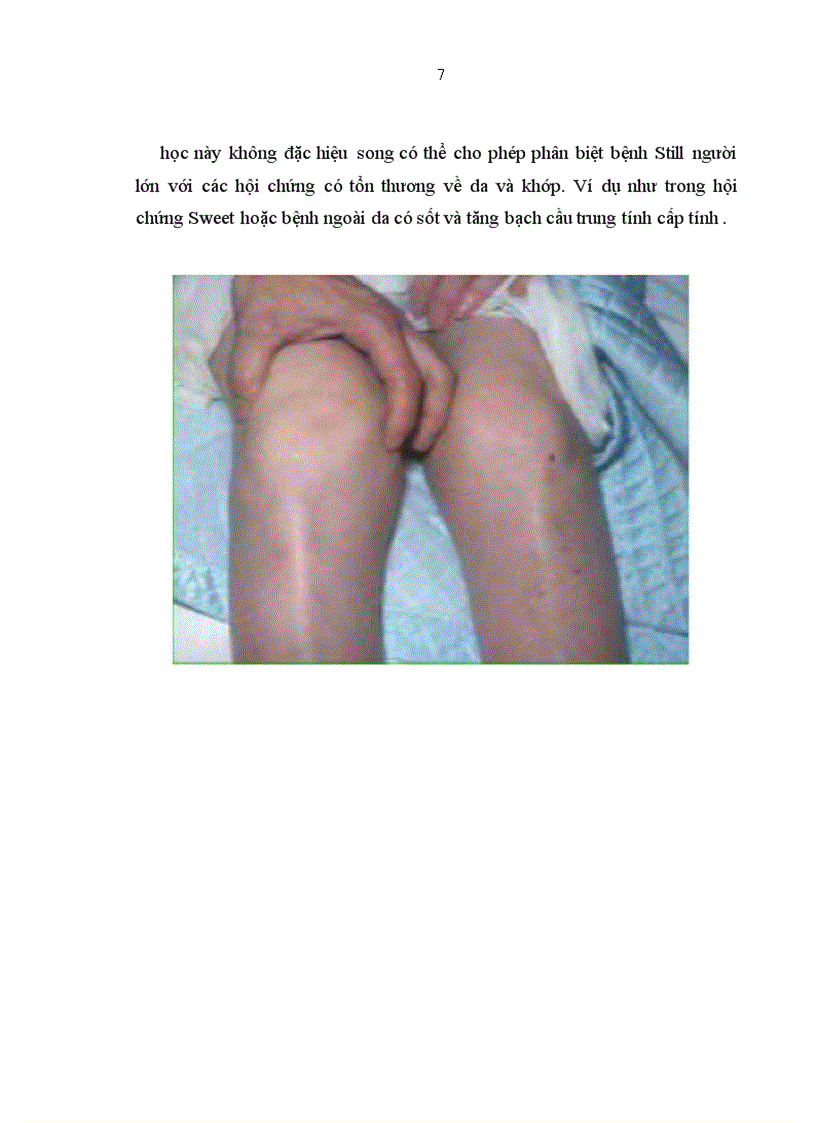 image for page Nghiên cứu áp dụng các tiêu chuẩn chẩn đoán bệnh Still người lớn