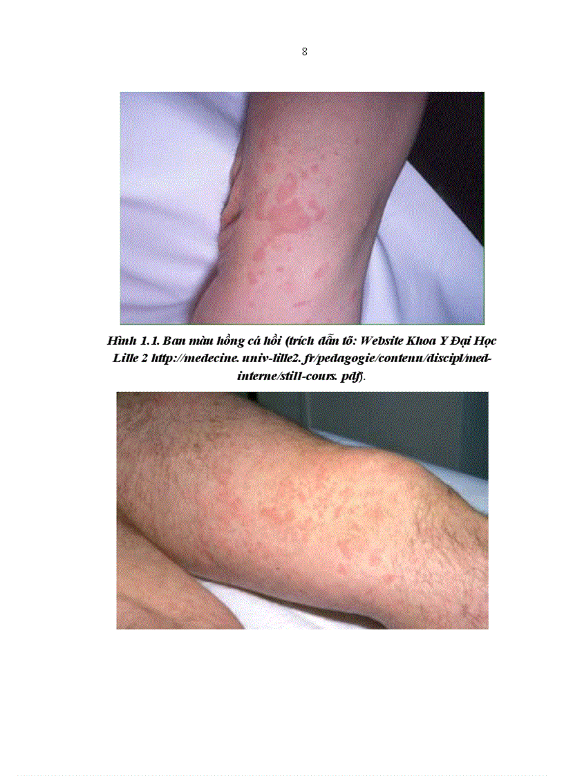 image for page Nghiên cứu áp dụng các tiêu chuẩn chẩn đoán bệnh Still người lớn