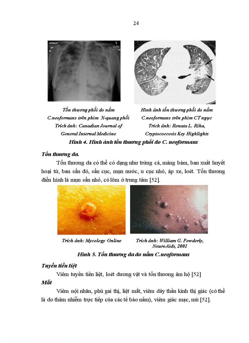 image for page Đánh giá kết quả điều trị viêm màng não do nấm Cryptococcus neoformans ở bệnh nhân HIV/AIDS.