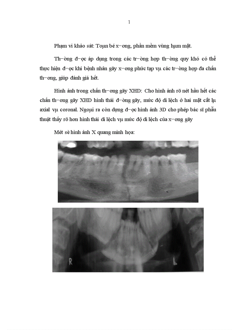 image for page Nhận xột đặc điểm lõm sàng X quang và kết quả điều trị góy XHD vùng cằm do chấn thương tại Bệnh viện Răng Hàm Mặt trung ương 2010 2011