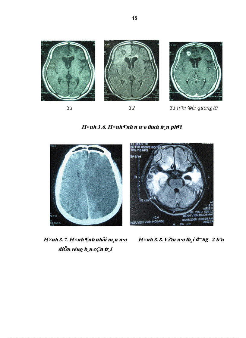 image for page Nghiên cứu một số đặc điểm lâm sàng và hình ảnh học của động kinh ở người trưởng thành tại Khoa Thần kinh Bệnh viện Bạch Mai