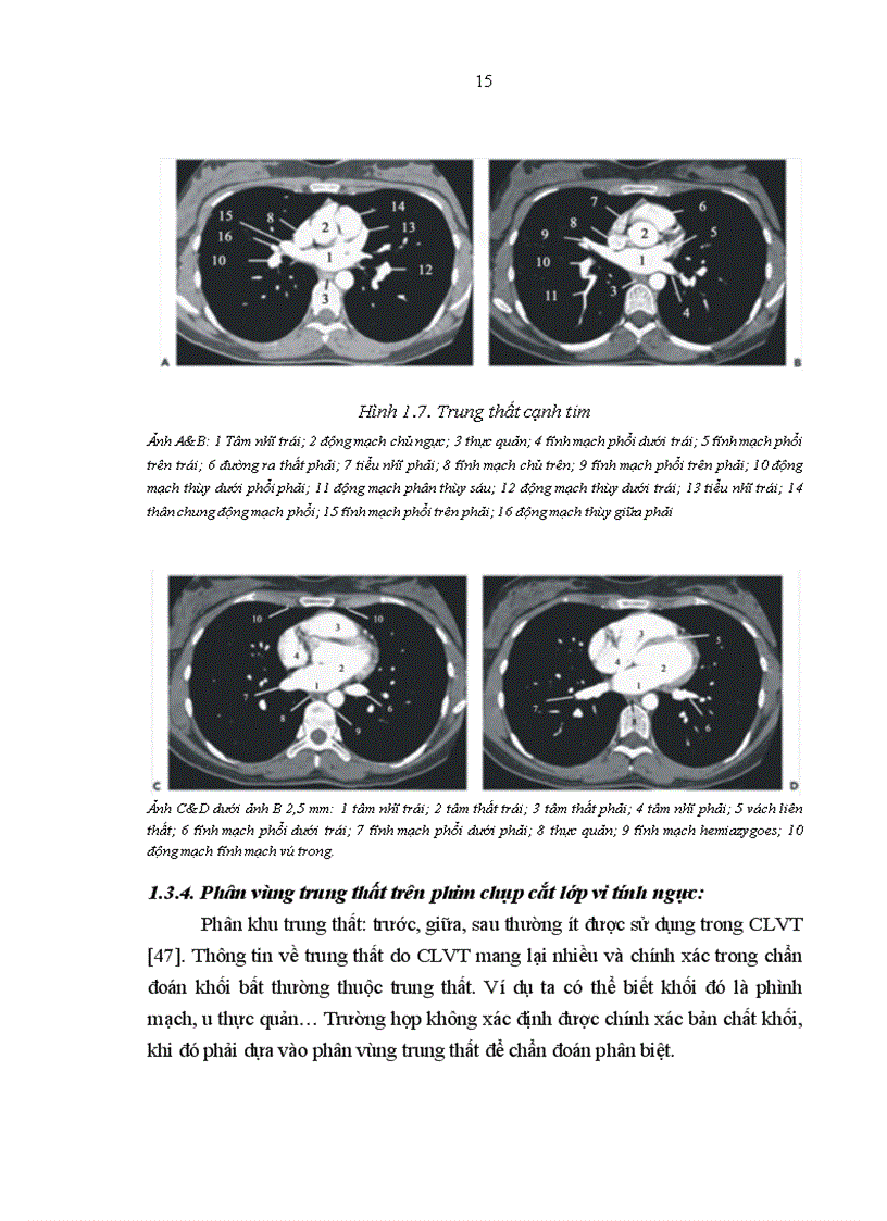 image for page Mô tả đặc điểm hình ảnh và giá trị chẩn đoán của cắt lớp vi tính đối với U quái trung thất