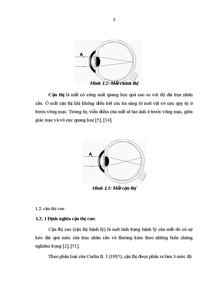 image for page Mô tả những biểu hiện của mắt cận thị cao trên lâm sàng cận lâm sàng siêu âm điện võng mạc và chụp cắt lớp võng mạc 1