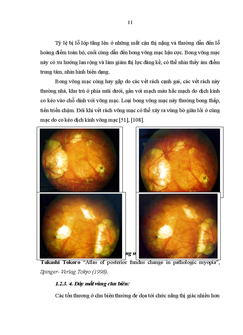 image for page Mô tả những biểu hiện của mắt cận thị cao trên lâm sàng cận lâm sàng siêu âm điện võng mạc và chụp cắt lớp võng mạc 1