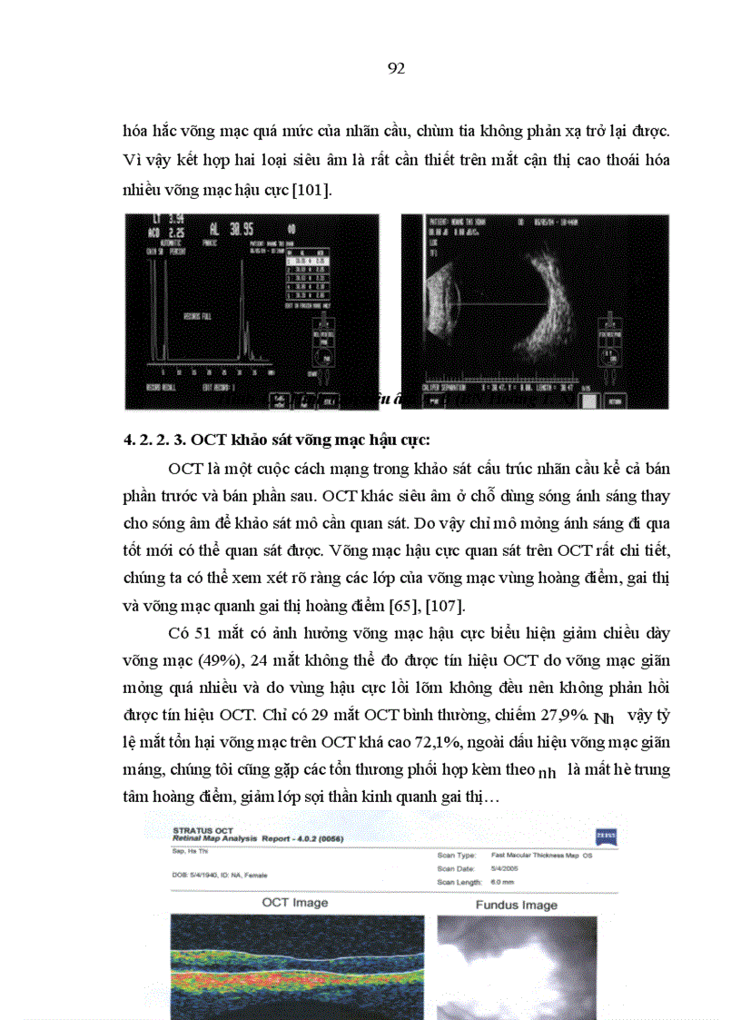 image for page Mô tả những biểu hiện của mắt cận thị cao trên lâm sàng cận lâm sàng siêu âm điện võng mạc và chụp cắt lớp võng mạc 1