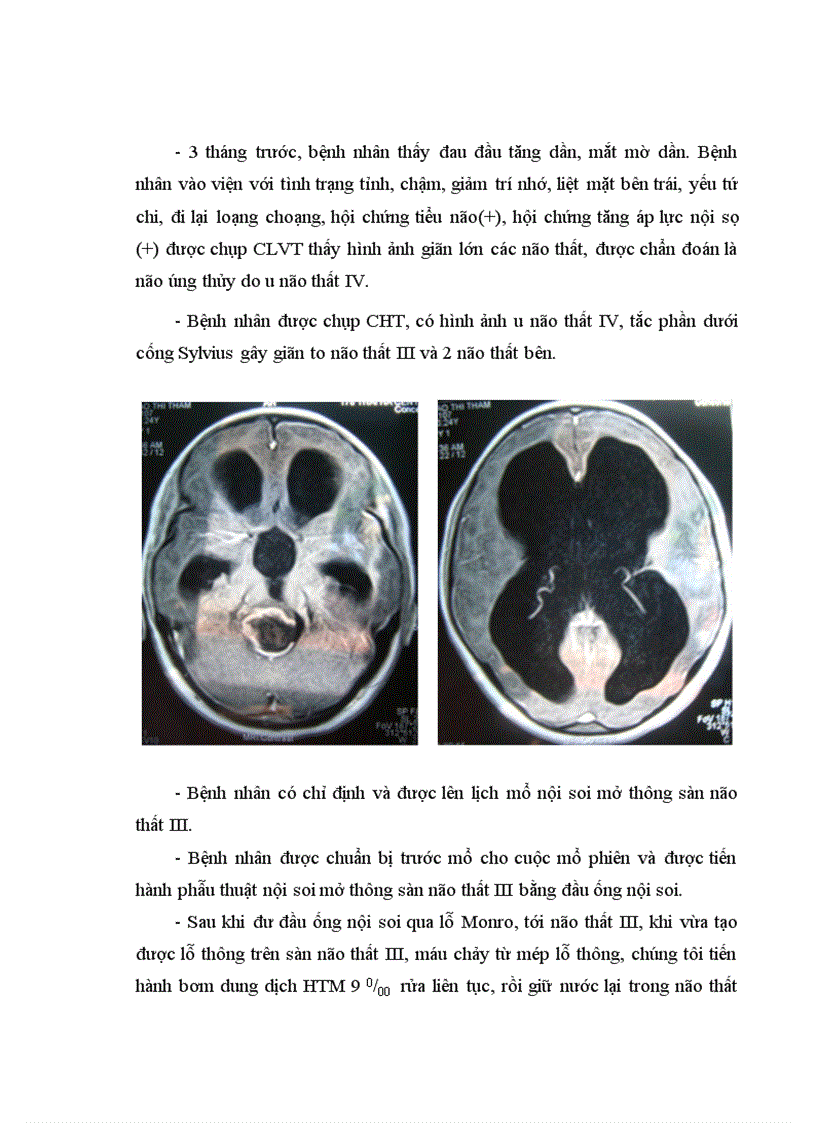 image for page Đánh giá kết quả phẫu thuật nội soi mở thông sàn não thất III ở bệnh nhân não úng thủy thể tắc nghẽn