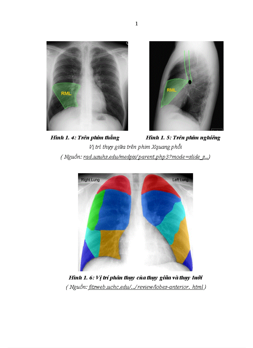 image for page Nghiên cứu đặc điểm lâm sàng cận lâm sàng nguyên nhân ở bệnh nhân có tổn thương phổi thùy giữa điều trị tại khoa Hô hấp Bệnh viện Bạch Mai 1