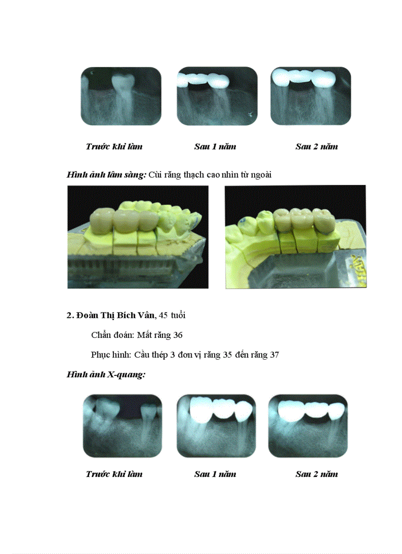 image for page Nghiên cứu răng trụ và đánh giá hiệu quả của cầu cổ điển