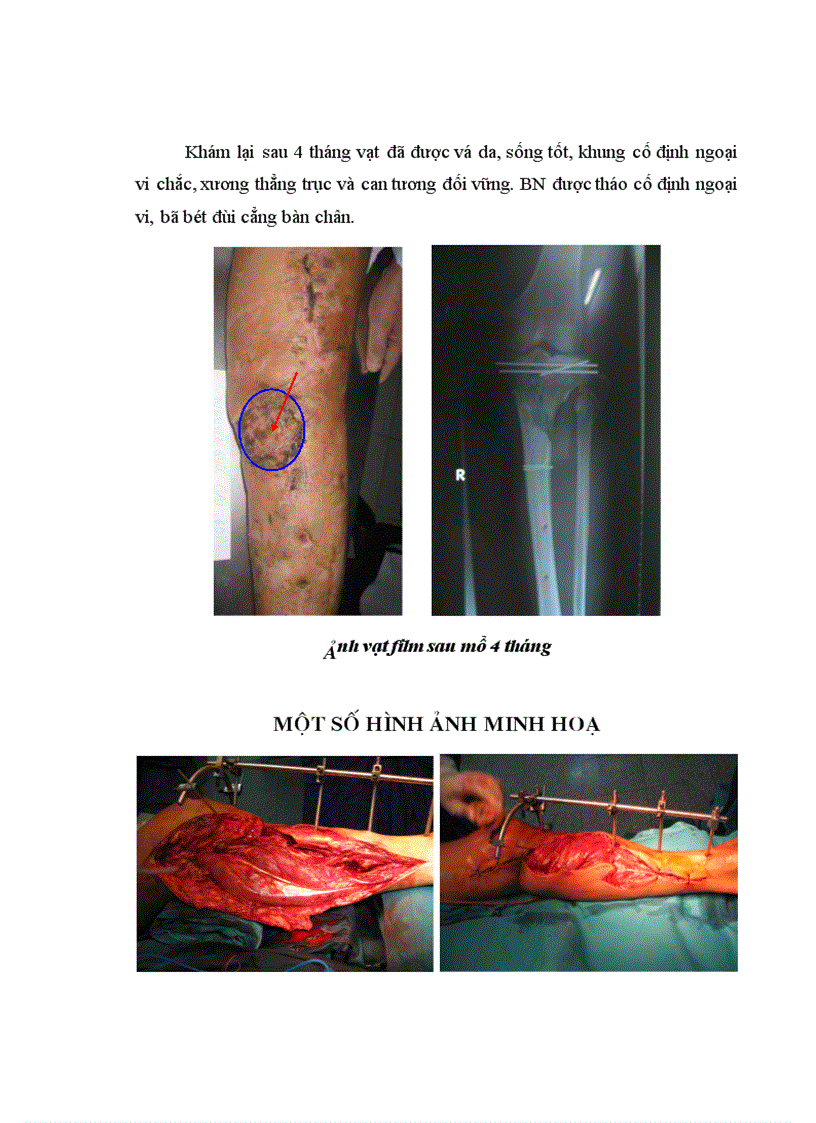 image for page Nghiên cứu kết quả điều trị khuyết hổng phần mềm 2 3 trên cẳng chân bằng vạt cơ BCT tại Bệnh viện Việt Đức