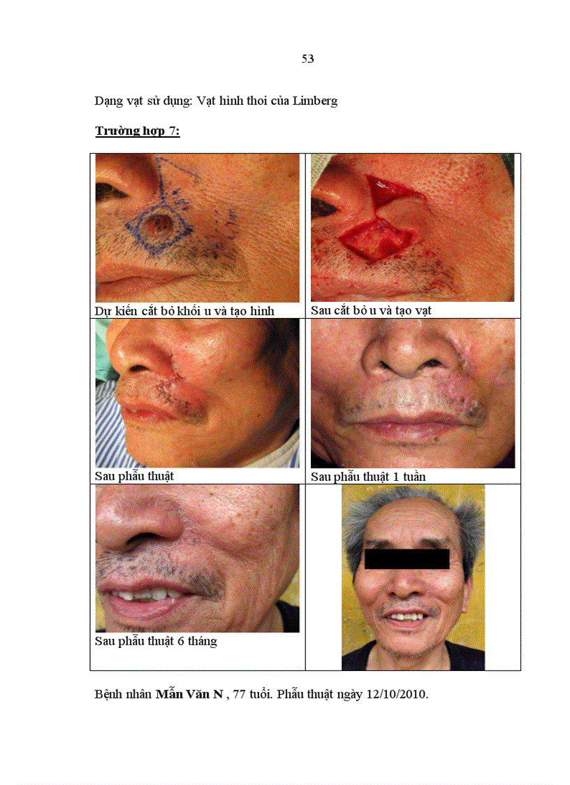 image for page Đánh giá kết quả sử dụng vạt hình thoi trong tạo hình phần mềm vùng mặt