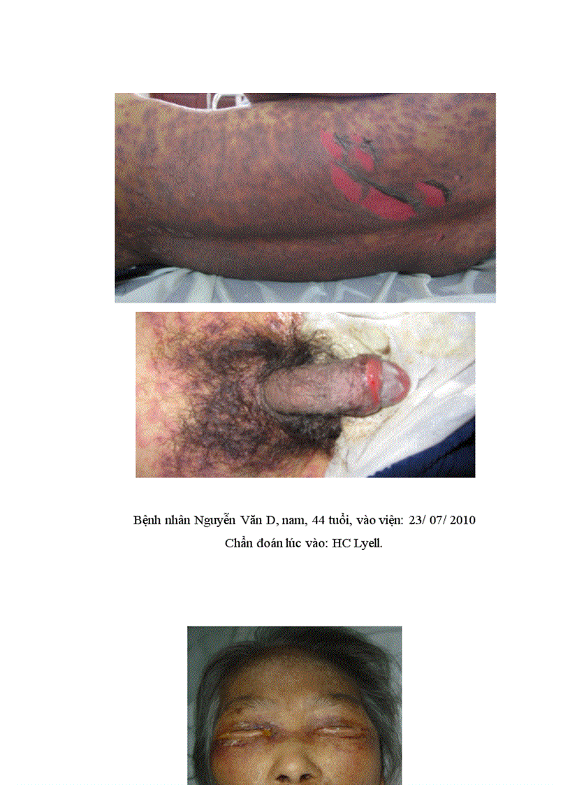 image for page Nghiên cứu đặc điểm lâm sàng cận lâm sàng và kết quả điều trị HC Lyell tại Bệnh viện Da liễu Trung ương