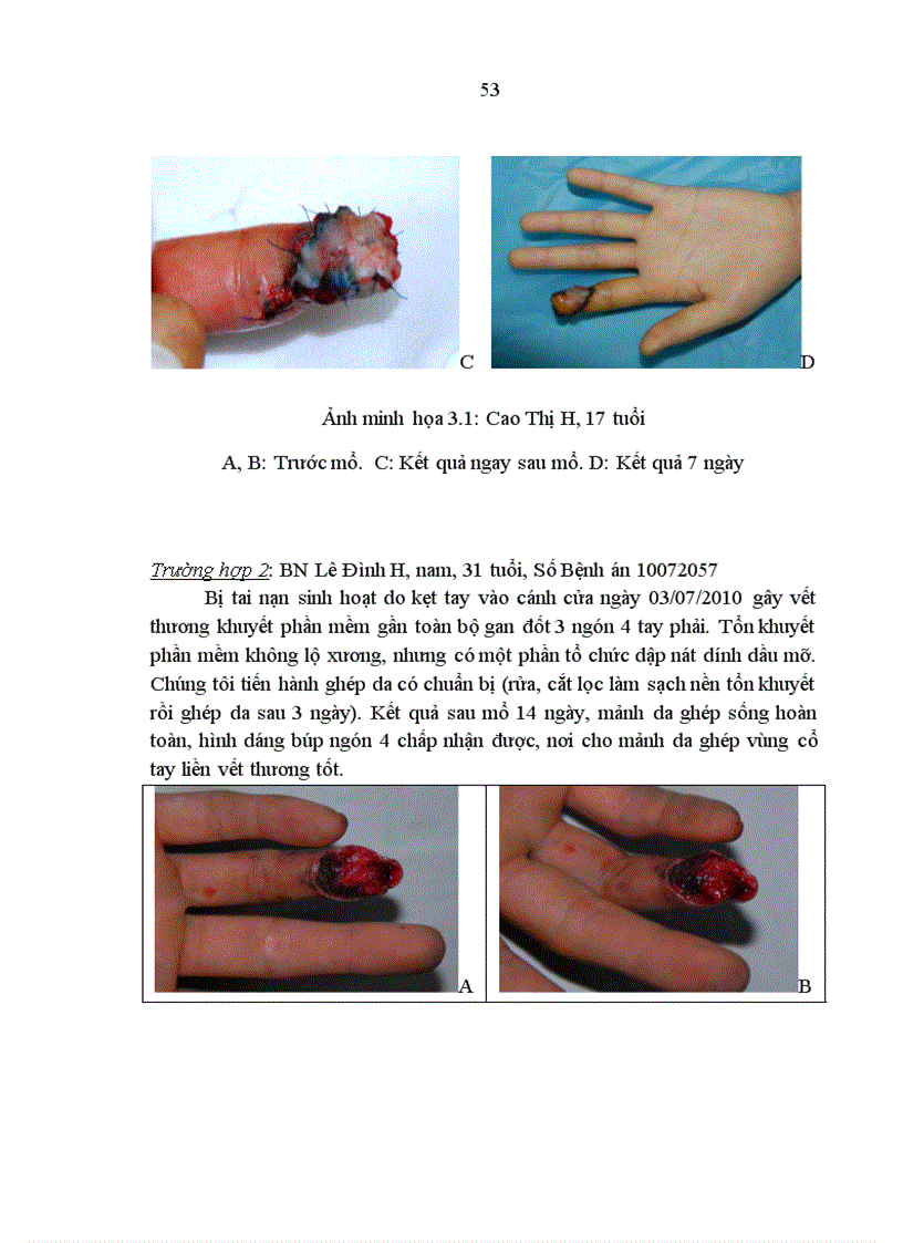 image for page Nghiên cứu đặc điểm tổn thương và đánh giá kết quả điều trị vết thương bàn tay tại Bệnh viện Xanh Pôn 1