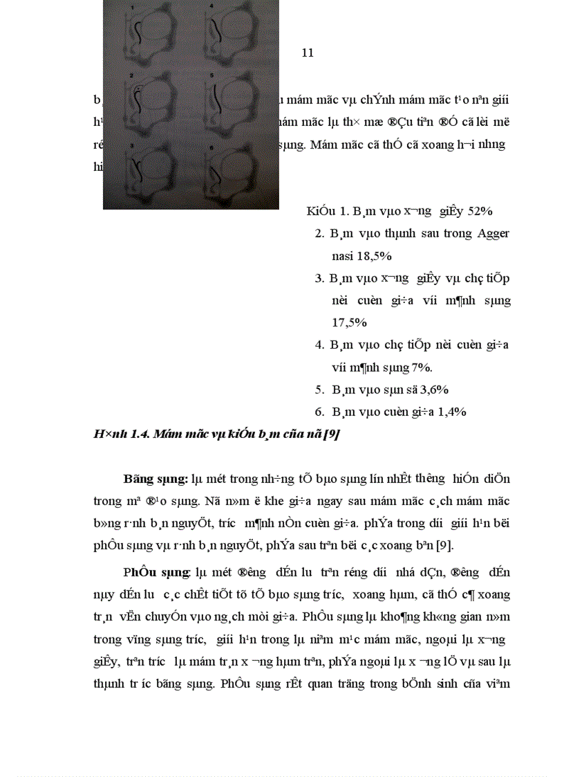 image for page Nghiên cứu hình thái lâm sàng của dị hình cuốn mũi giữa trong bệnh lý mũi xoang qua nội soi và chụp cắt lớp vi tính