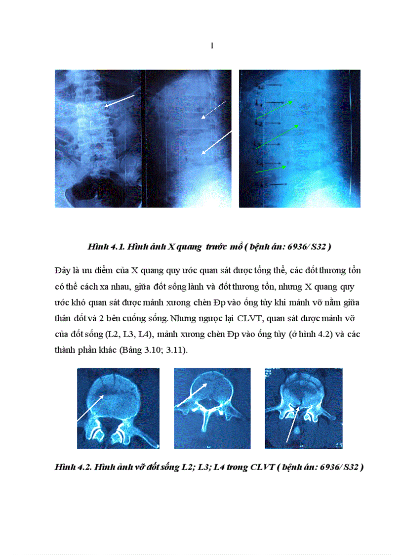 image for page Nghiên cứu đặc điểm lâm sàng chẩn đoán hình ảnh và kết quả điều trị phẫu thuật chấn thương cột sống đoạn bản lề Ngực Thắt lưng có liệt
