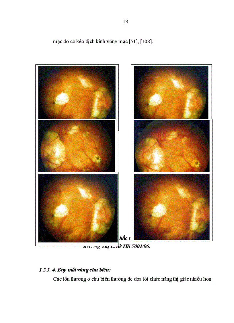 image for page Nghiên cứu đặc điểm lâm sàng cận lâm sàng của bệnh cận thị người trưởng thành và kết quả điều trị bằng phương pháp tán nhuyễn thể thủy tinh