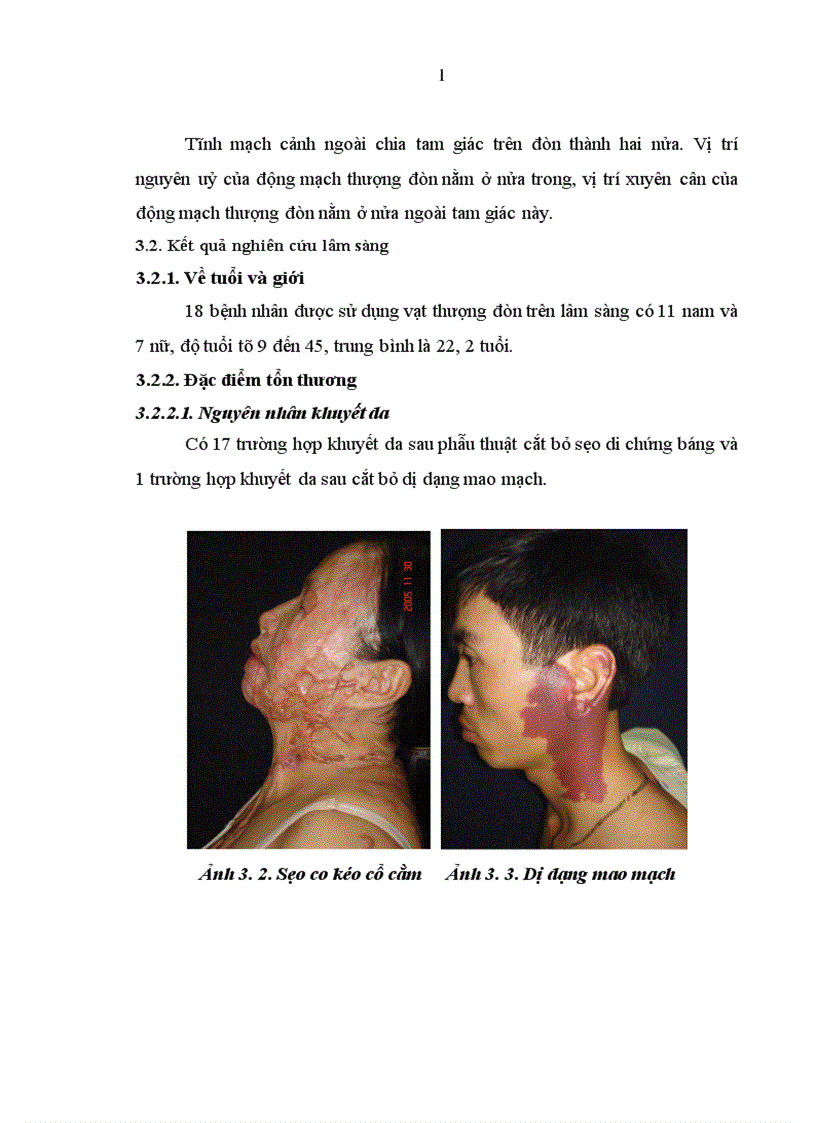 image for page Nghiên cứu đặc điểm giải phẫu và ứng dụng vạt da cân thượng đòn trong phẫu thuật tạo hình