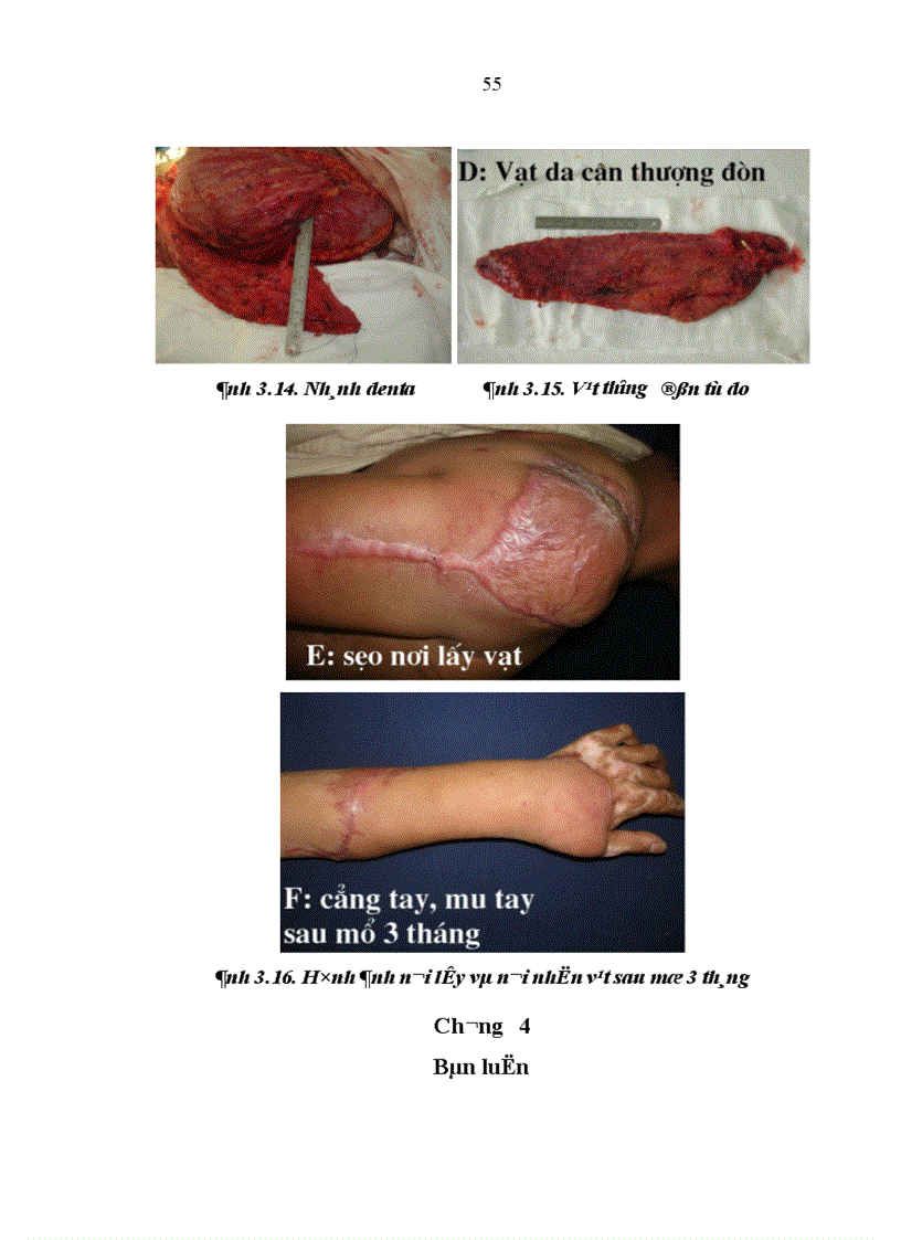 image for page Nghiên cứu đặc điểm giải phẫu và ứng dụng vạt da cân thượng đòn trong phẫu thuật tạo hình