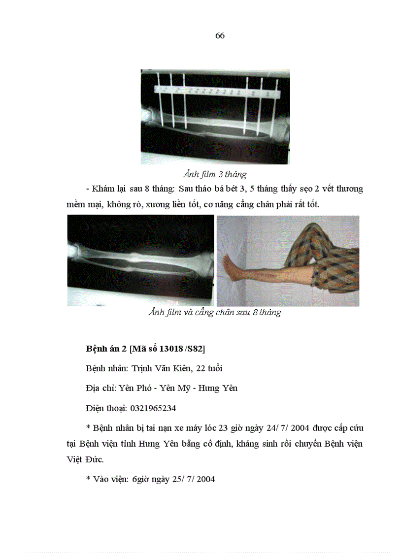 image for page Đánh giá tác dụng khung CĐN FESSA trong điều trị gãy hở xương cẳng chân tại Bệnh viện Việt Đức trong năm 2004 2005