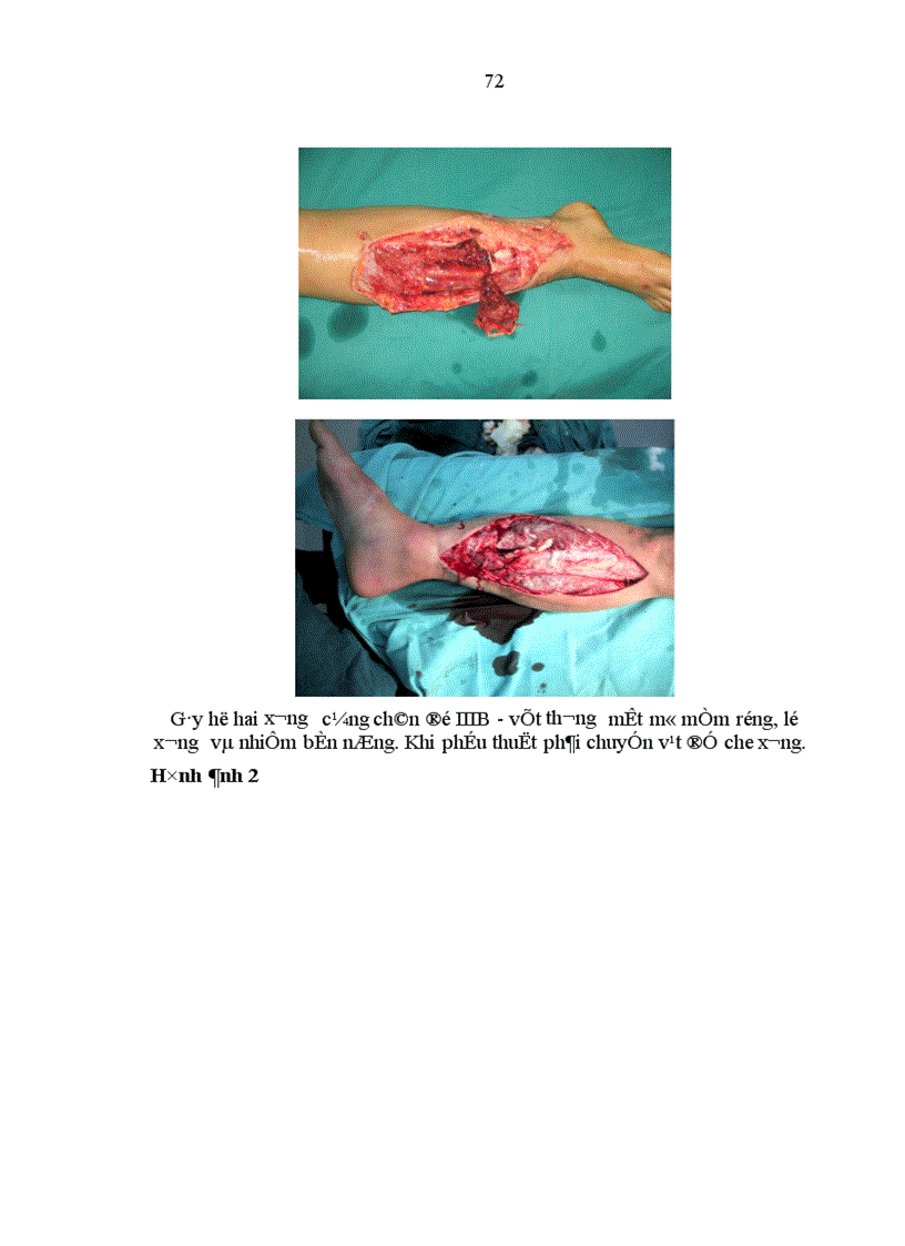 image for page Đánh giá tác dụng khung CĐN FESSA trong điều trị gãy hở xương cẳng chân tại Bệnh viện Việt Đức trong năm 2004 2005