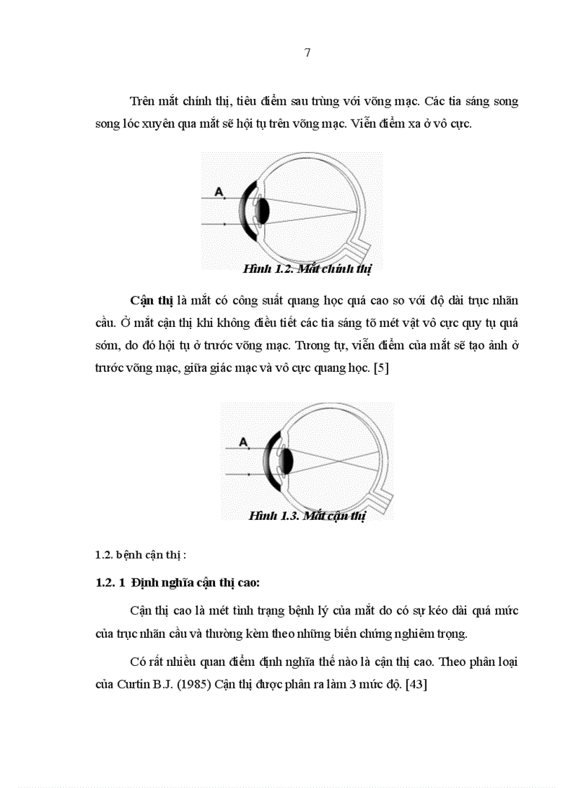 image for page Nghiên cứu đặc điểm lâm sàng cận lâm sàng của bệnh cận thị người trưởng thành và kết quả điều trị bằng phương pháp tán nhuyễn thể thủy tinh 1