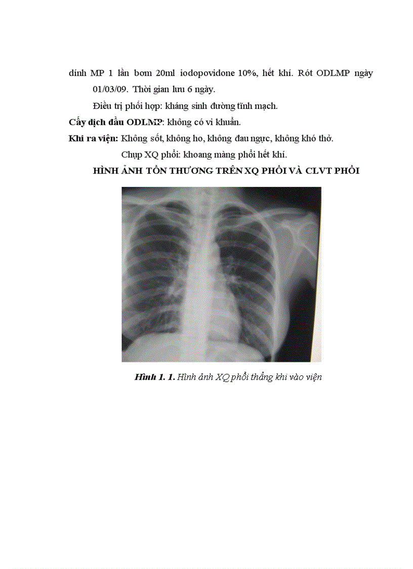 image for page Nghiên cứu đặc điểm lâm sàng cận lâm sàng và kết quả điều trị tràn khí màng phổi bằng gây dính màng phổi với iodopovidone qua ống dẫn lưu màng phổi