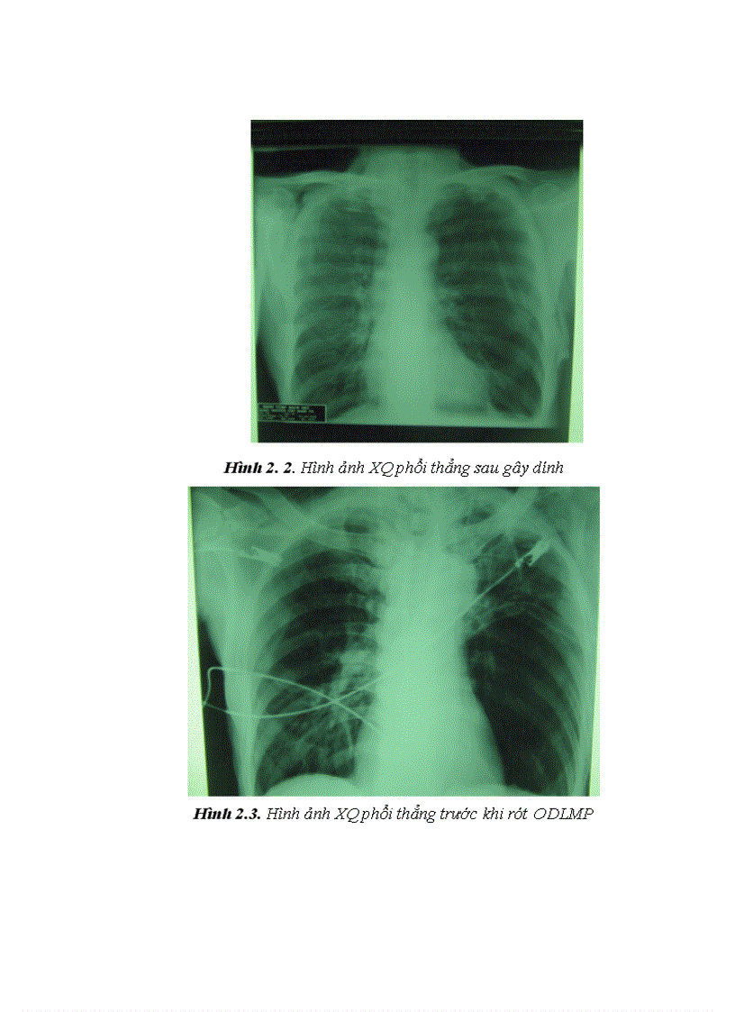 image for page Nghiên cứu đặc điểm lâm sàng cận lâm sàng và kết quả điều trị tràn khí màng phổi bằng gây dính màng phổi với iodopovidone qua ống dẫn lưu màng phổi