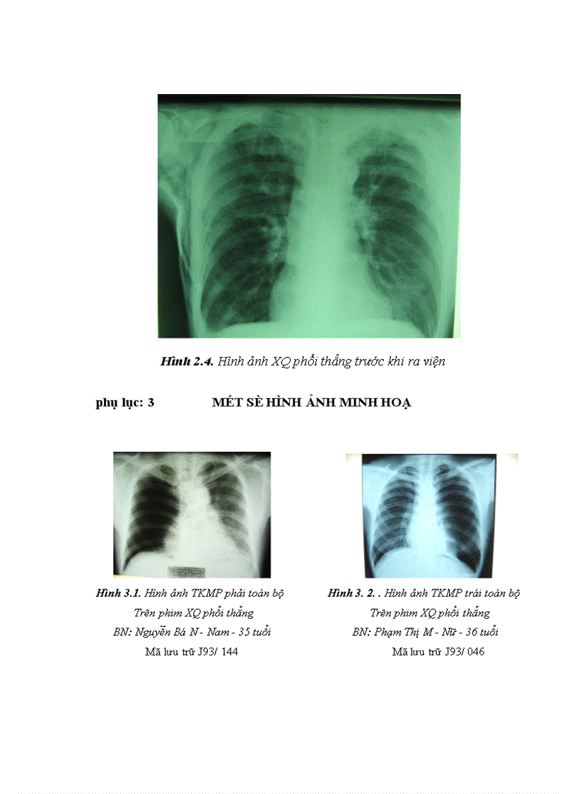 image for page Nghiên cứu đặc điểm lâm sàng cận lâm sàng và kết quả điều trị tràn khí màng phổi bằng gây dính màng phổi với iodopovidone qua ống dẫn lưu màng phổi