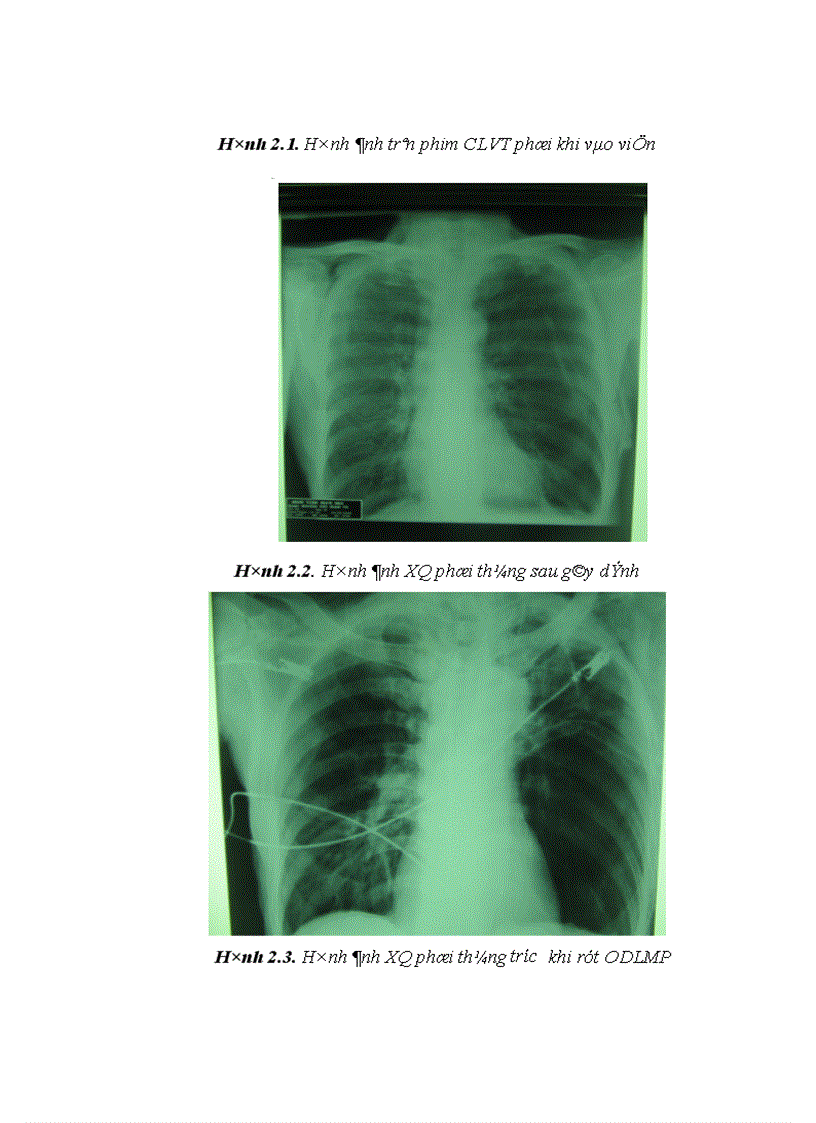 image for page Nghiên cứu đặc điểm lâm sàng cận lâm sàng và kết quả điều trị tràn khí màng phổi bằng gây dính màng phổi với iodopovidone qua ống dẫn lưu màng phổi