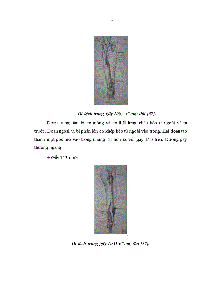 image for page Đánh giá kết qủa điều trị gẫy kín thân xương đùi trẻ em do chấn thương bằng kết hợp xương tại Bệnh viện Việt Đức 1