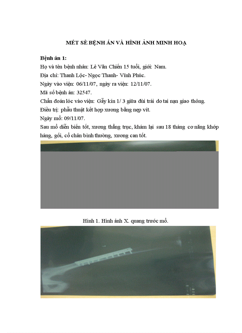 image for page Đánh giá kết qủa điều trị gẫy kín thân xương đùi trẻ em do chấn thương bằng kết hợp xương tại Bệnh viện Việt Đức 1