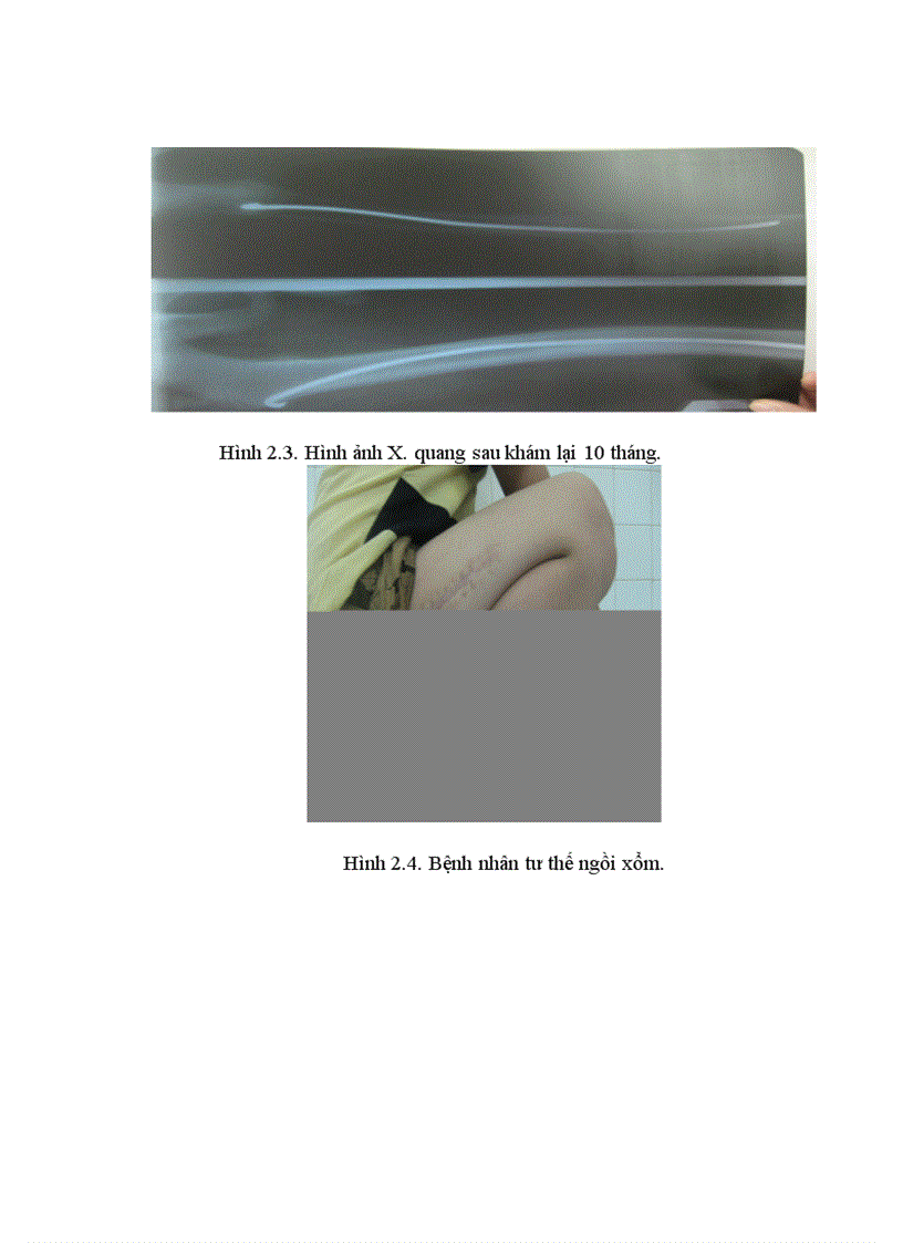 image for page Đánh giá kết qủa điều trị gẫy kín thân xương đùi trẻ em do chấn thương bằng kết hợp xương tại Bệnh viện Việt Đức 1