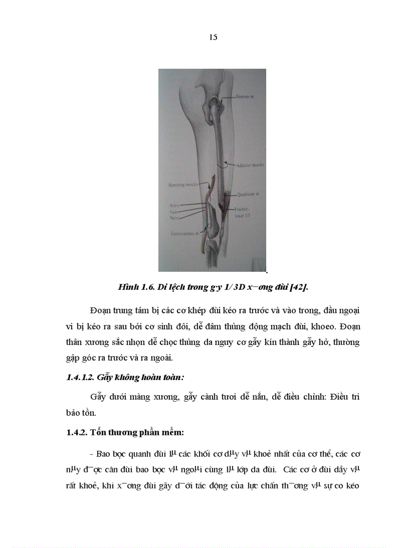 image for page Đánh giá kết qủa điều trị gẫy kín thân xương đùi trẻ em do chấn thương bằng kết hợp xương tại Bệnh viện Việt Đức 1