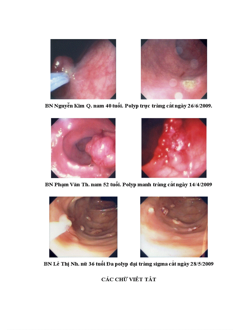image for page Nhận xét hình ảnh nội soi mô bệnh học của polyp đại trực tràng và kết quả cắt polyp bằng nguồn cắt ENDOPLASMA