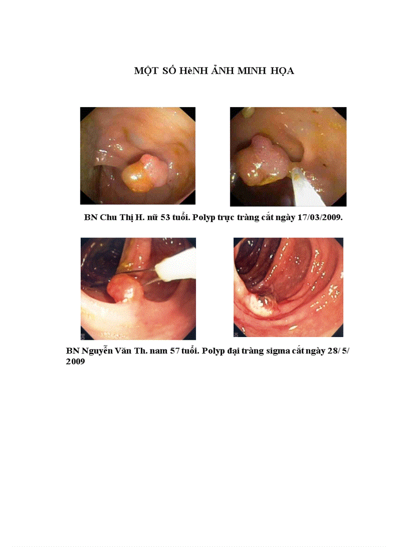 image for page Nhận xét hình ảnh nội soi mô bệnh học của polyp đại trực tràng và kết quả cắt polyp bằng nguồn cắt ENDOPLASMA