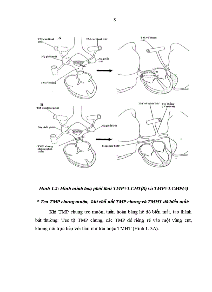 image for page Nghiên cứu đặc điểm lâm sàng cận lâm sàng bệnh tĩnh mạch phổi về lạc chỗ hoàn toàn ở trẻ em