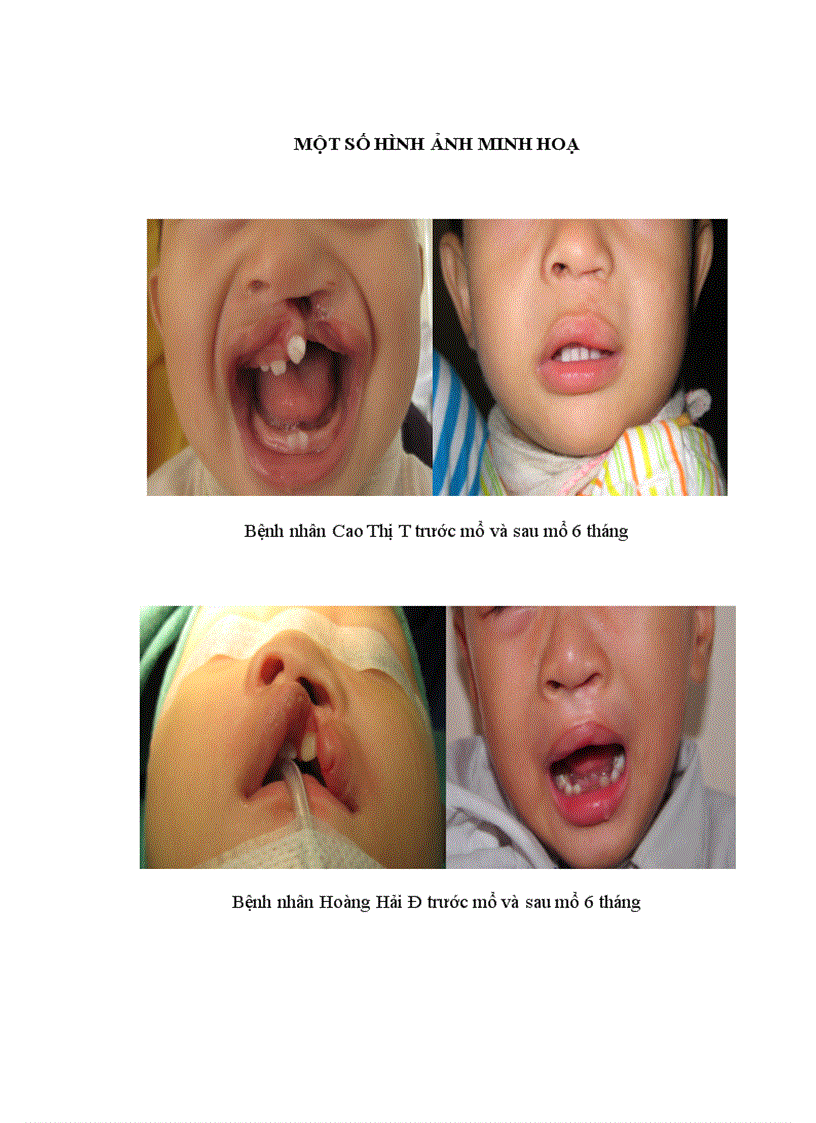 image for page Đánh giá vai trò tạo hình chữ Z ở trên đường viền da môi đỏ trong phương pháp Millard mổ khe hở môi một bên toàn bộ