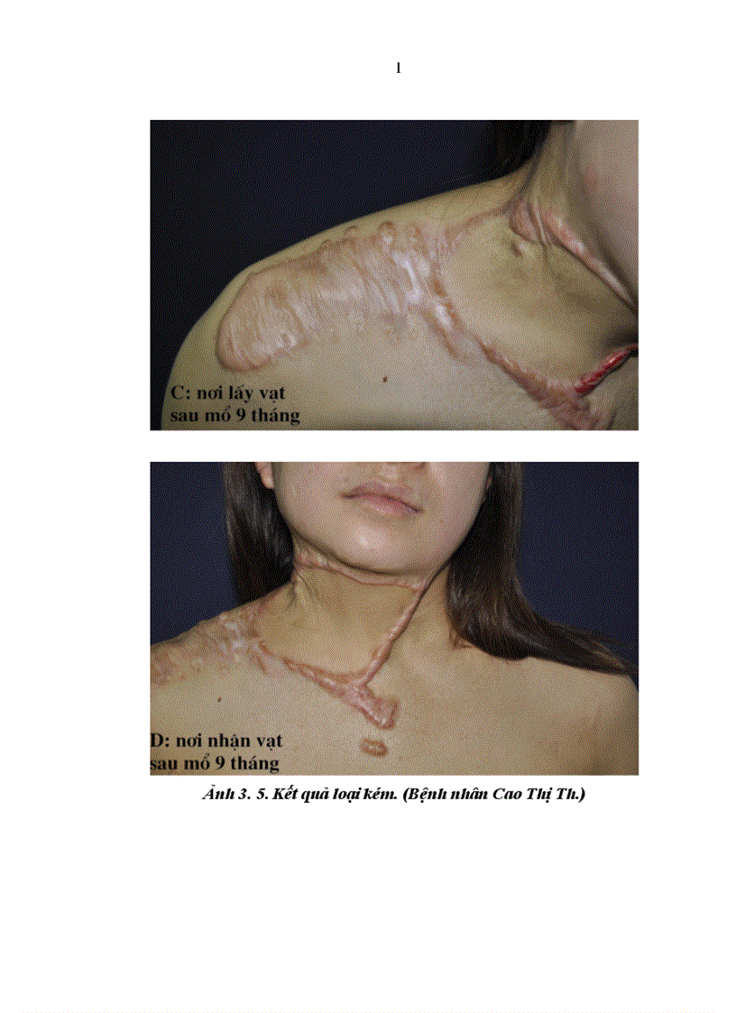 image for page Nghiên cứu đặc điểm giải phẫu và ứng dụng vạt da cân thượng đòn trong phẫu thuật tạo hình 1