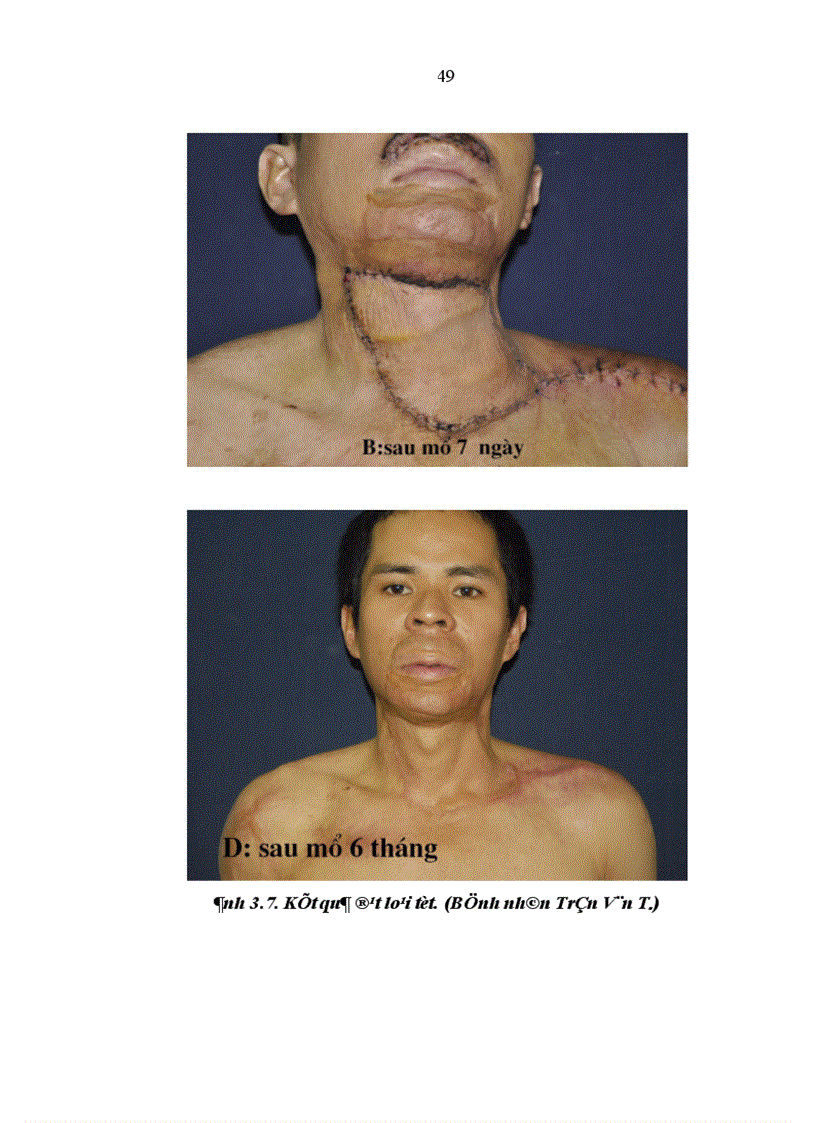 image for page Nghiên cứu đặc điểm giải phẫu và ứng dụng vạt da cân thượng đòn trong phẫu thuật tạo hình 1