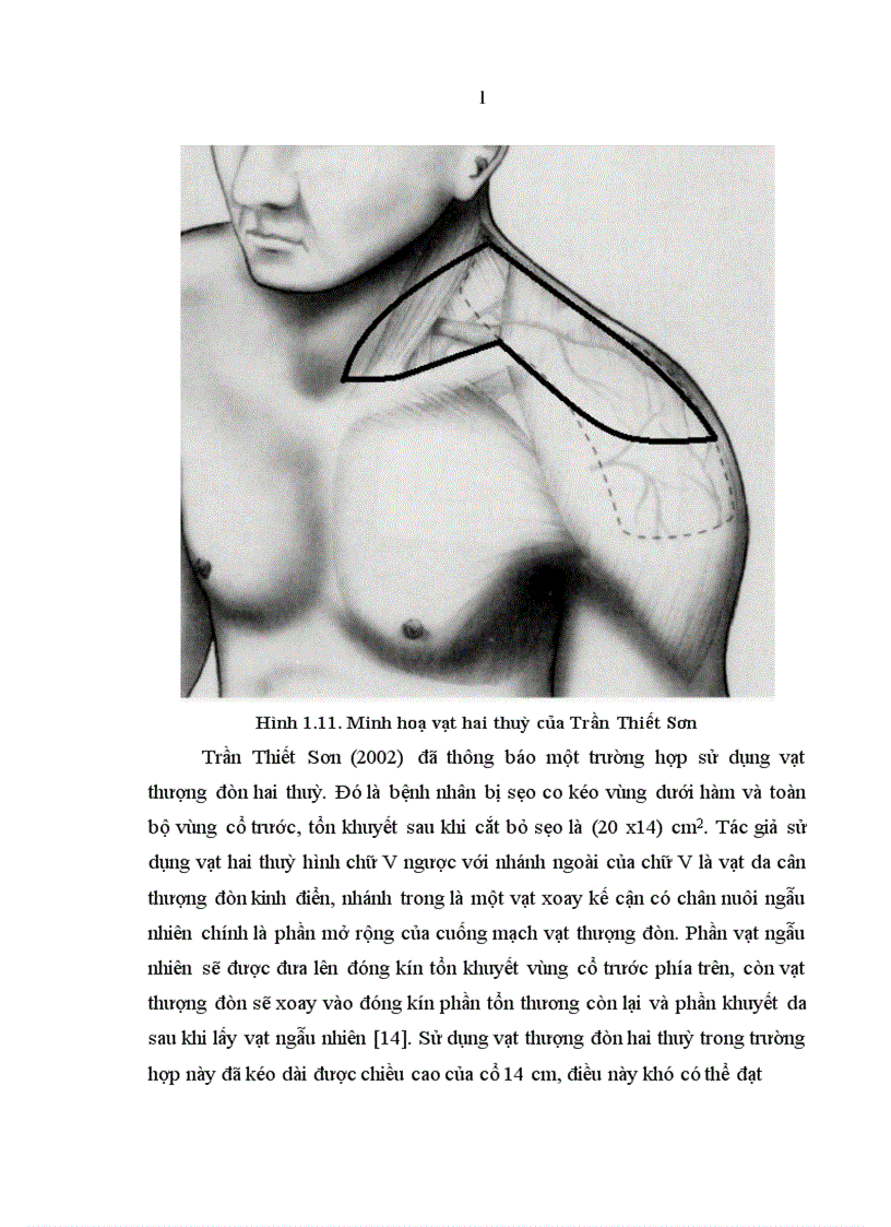 image for page Nghiên cứu đặc điểm giải phẫu và ứng dụng vạt da cân thượng đòn trong phẫu thuật tạo hình 1