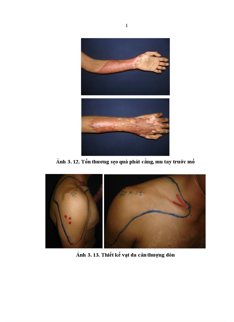 image for page Nghiên cứu đặc điểm giải phẫu và ứng dụng vạt da cân thượng đòn trong phẫu thuật tạo hình 1