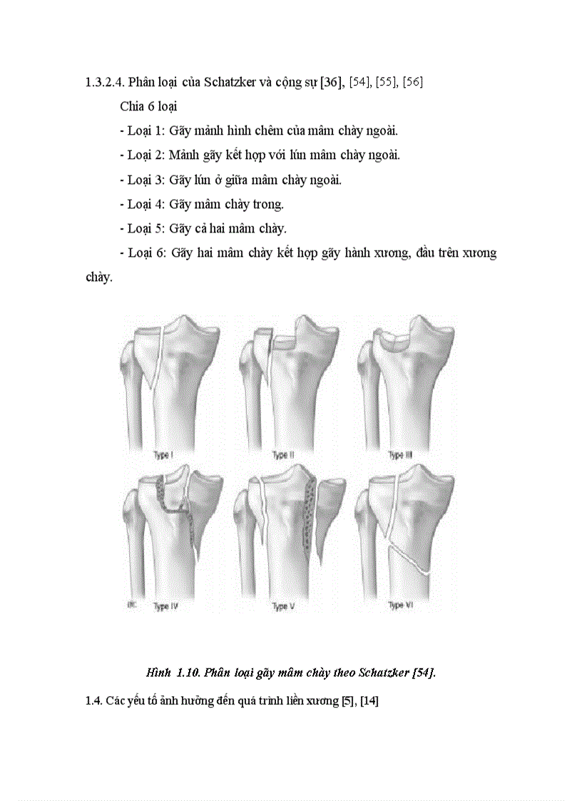 image for page Đánh giá kết quả điều trị gãy kín mâm chày do chấn thương bằng phương pháp kết hợp xương nẹp vít tại Viện CTCH Bệnh viện TƯQĐ 108