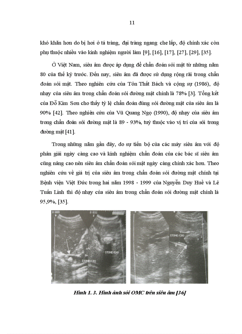 image for page Đánh giá kết quả của phương pháp phẫu thuật khâu kín ống mật chủ sau khi lấy sỏi để điều trị sỏi đường mật chính ngoài gan 1