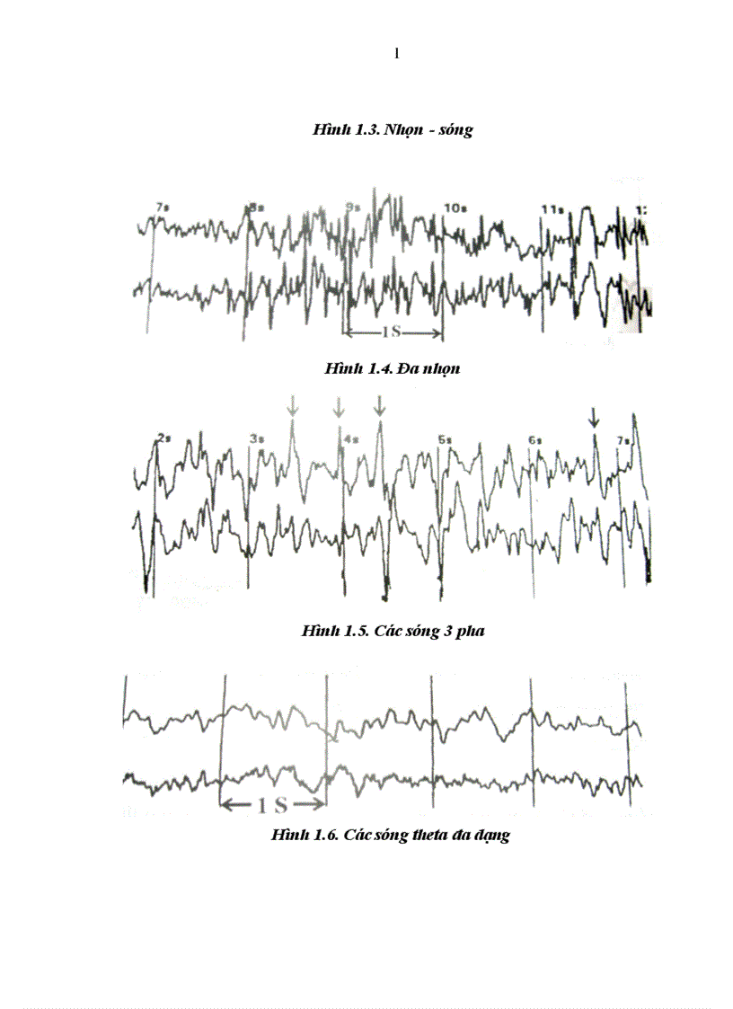 image for page Nghiên cứu một số đặc điểm lâm sàng và hình ảnh học của động kinh ở người trưởng thành tại Khoa Thần kinh Bệnh viện Bạch Mai 1