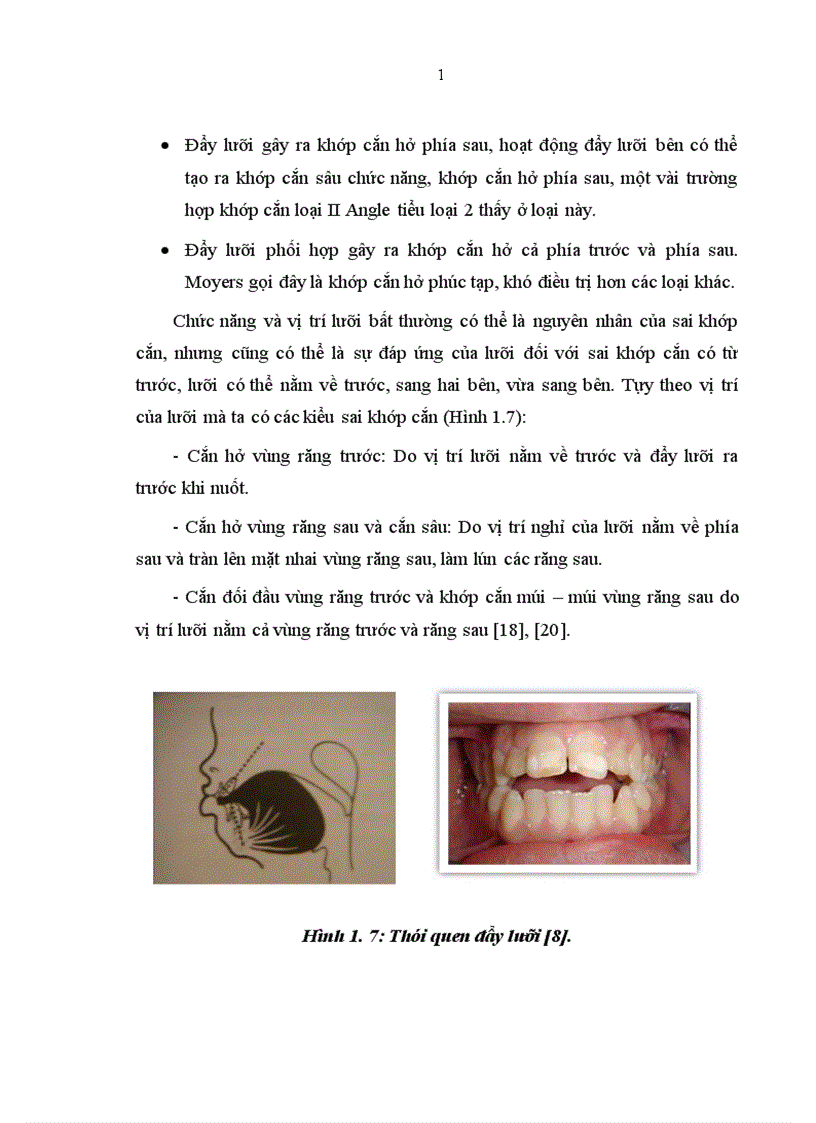 image for page Nhận xét mối liên quan giữa thói quen răng miệng xấu và lệch lạc khớp cắn ở trẻ em lứa tuổi 7 11 tại Trường tiểu học Tân Mai Hà Nội 1